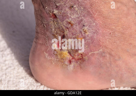 Medical Photo : Infection cellulite sur la peau d'une cheville causé par la phlébite et caillots de sang dans la veine. Banque D'Images