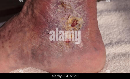 Medical Photo : Infection cellulite sur la peau d'une cheville causé par la phlébite et caillots de sang dans la veine. Banque D'Images