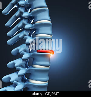 Image 3D de la hernie discale de la colonne vertébrale humaine Banque D'Images