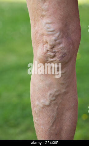 Swollend varices veines élargie et la peau déformée dans les genoux et les jambes d'une femme âgée uk Banque D'Images