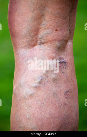 Swollend varices veines élargie et déformé dans la peau jambes femme âgée uk Banque D'Images
