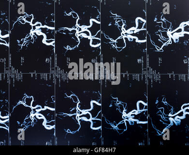 Image de la tête de l'IRM, les vaisseaux sanguins dans le cerveau Banque D'Images