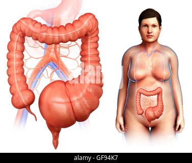 Illustration d'un mégacôlon toxique. Banque D'Images
