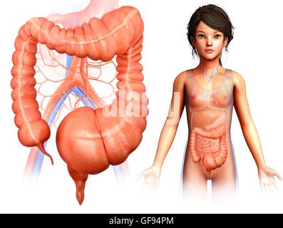 Illustration d'un mégacôlon toxique. Banque D'Images