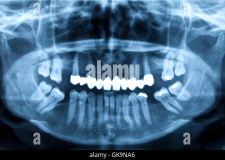 Mâchoire inférieure de un adulte avec de mauvaises dents dans la radiographie Banque D'Images