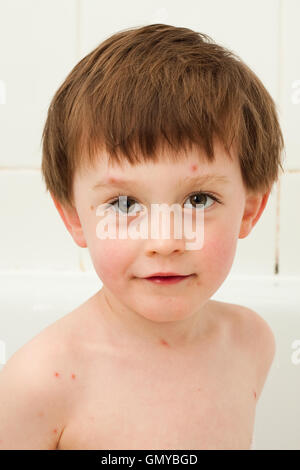 Enfant Avec La Varicelle Photo Stock Alamy