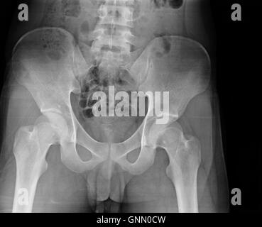 X-ray du bassin et de la colonne vertébrale. Banque D'Images