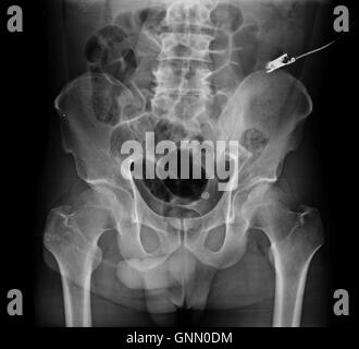 X-ray du bassin et de la colonne vertébrale. Banque D'Images