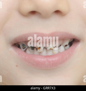 Rapprochée sur les dents de bébé avec la carie dentaire Banque D'Images