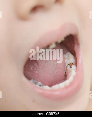 Rapprochée sur les dents de bébé avec la carie dentaire Banque D'Images