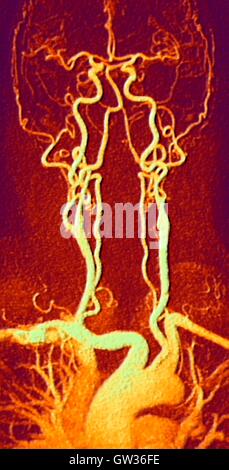 Poitrine, le cou et la tête d'artères. L'angiographie par résonance magnétique de couleur (ARM) analyse d'un système normal de la carotide d'un homme âgé de 55 ans. En bas au centre est l'arc aortique, qui vire au-dessus du cœur. Les artères qui partent de ces sont les suivants : l'brachiocepha Banque D'Images