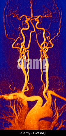 Poitrine, le cou et la tête d'artères. L'angiographie par résonance magnétique de couleur (ARM) analyse d'un système normal de la carotide d'un homme âgé de 55 ans. En bas au centre est l'arc aortique, qui vire au-dessus du cœur. Les artères qui partent de ces sont les suivants : l'brachiocepha Banque D'Images