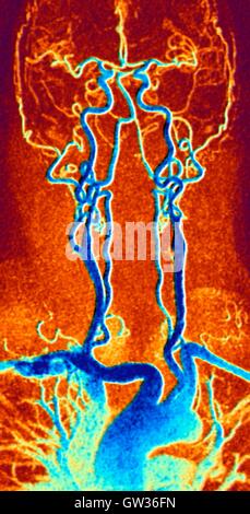 Poitrine, le cou et la tête d'artères. L'angiographie par résonance magnétique de couleur (ARM) analyse d'un système normal de la carotide d'un homme âgé de 55 ans. En bas au centre est l'arc aortique, qui vire au-dessus du cœur. Les artères qui partent de ces sont les suivants : l'brachiocepha Banque D'Images
