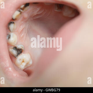 Gros plan de la carie de bébé Banque D'Images
