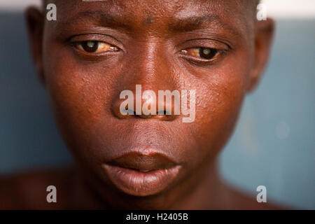 Hôpital Ribaue, Ribaue, province de Nampula, Mozambique, Août 2015 : . Laurinda de Diago Lalaua bilatéral a la cataracte. Elle a été diagnostiqué avec des cataractes bilatérales par l'équipe de sensibilisation de Nampula et Ribaue. Elle aura son cataratcs enlevé à Ribaue Hôpital. Ce projet est soutenu par Sightsavers. Photo de Mike Goldwater Banque D'Images