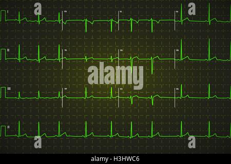 Les droits de l'électrocardiogramme typique, graphique vert clair sur fond sombre Illustration de Vecteur