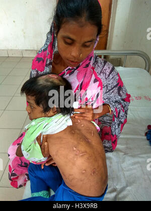 Dhaka 02 octobre 2016. Une femme montrant les cicatrices sur le corps de sa fille de 7 ans, à l'Jannat dirigé de de Dhaka Medical College Hospital récemment. Jannat, qui a travaillé en tant qu'enfant servante à Gazipur, près de la capitale du Bangladesh, était souvent battu son employeur, une femme au foyer. La dame a également utilisé pour brûler plusieurs parties du corps de la jeune fille avec un fer chaud et les ustensiles. Banque D'Images