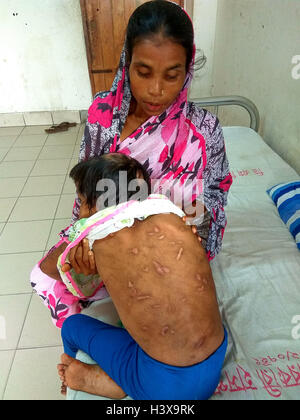 Dhaka 02 octobre 2016. Une femme montrant les cicatrices sur le corps de sa fille de 7 ans, à l'Jannat dirigé de de Dhaka Medical College Hospital récemment. Jannat, qui a travaillé en tant qu'enfant servante à Gazipur, près de la capitale du Bangladesh, était souvent battu son employeur, une femme au foyer. La dame a également utilisé pour brûler plusieurs parties du corps de la jeune fille avec un fer chaud et les ustensiles. Banque D'Images