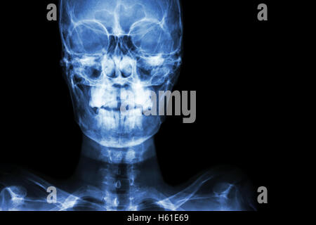 Film x-ray crâne AP : montrer le crâne humain normal et la zone vide du côté droit Banque D'Images