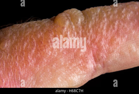 Macro Close up poison ivy rash vésicules sur la peau humaine Banque D'Images