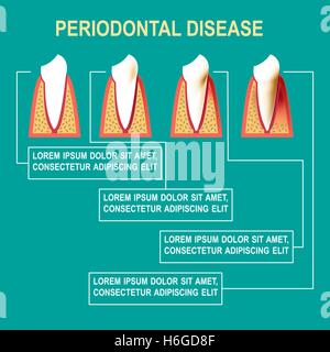La maladie parodontale Vector illustration Illustration de Vecteur