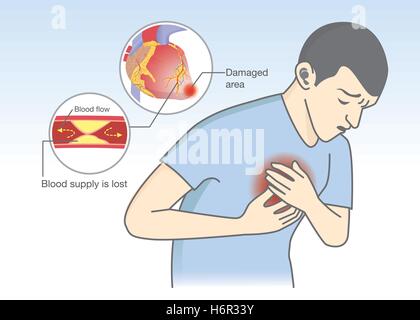 Cause de symptômes de la crise cardiaque à partir de l'écoulement de sang sont bloqués. Illustration de Vecteur