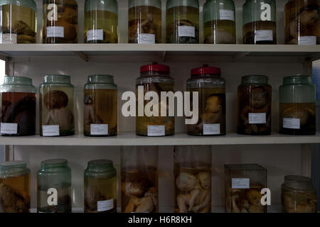 Bols de fœtus présentant des défauts de l'exposition à la dioxine de l'agent Orange utilisé durant la guerre du Vietnam, Tu Do Hospital Ho Chi Minh city Banque D'Images