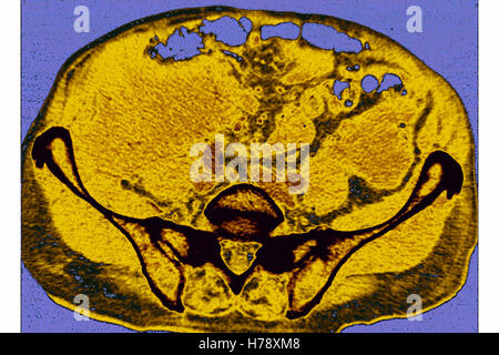 CT-SCAN de l'Amylose Banque D'Images