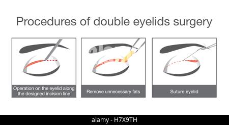 Les procédures de la chirurgie des paupières double. Illustration de Vecteur