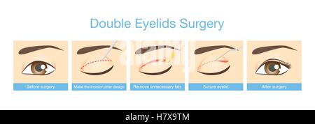 Les procédures de la chirurgie des paupières double. Illustration de Vecteur