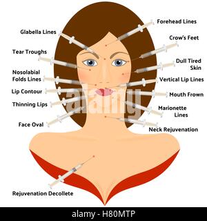 Acide hyaluronique Asid Infographie. La chirurgie plastique Face Illustration de Vecteur