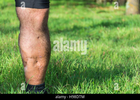 Vieille cicatrice de blessure à la jambe, de voiture ou d'accident de moto, des tissus profonds cicatrice , homme glabre de jambe, blessure à un mollet , grande cicatrice sur le mollet droit. Les cicatrices que Banque D'Images