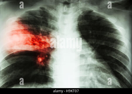 La pneumonie lobaire . film radiographie de montrer l'infiltration alvéolaire du lobe moyen droit dû à la tuberculose infection . Banque D'Images