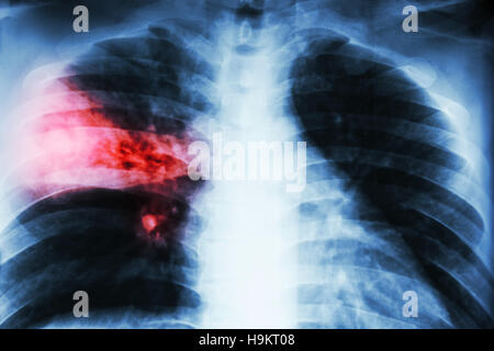 La pneumonie lobaire . film radiographie de montrer l'infiltration alvéolaire du lobe moyen droit dû à la tuberculose infection . Banque D'Images