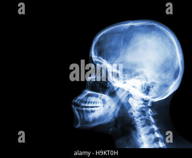 Film x-ray du crâne et de la colonne cervicale vue latérale . zone vide du côté gauche Banque D'Images