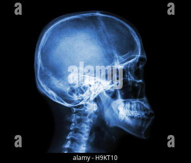 Film x-ray du crâne et de la colonne cervicale vue latérale. Banque D'Images