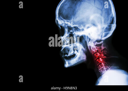 La spondylose cervicale . film x-ray vue latérale du crâne et la douleur au cou . Banque D'Images