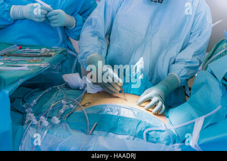 Surgeon making incision- Coeur de remplacement valvulaire, salle d'opération, Reykjavik, Islande Banque D'Images