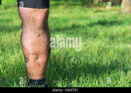 Vieille cicatrice de blessure à la jambe, de voiture ou d'accident de moto, des tissus profonds cicatrice , homme glabre de jambe, blessure à un mollet , grande cicatrice sur le mollet droit. Les cicatrices que Banque D'Images