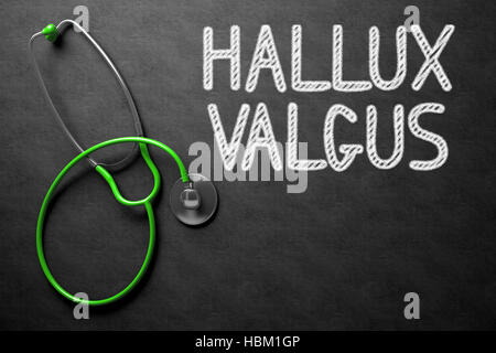 Tableau sur l'hallux valgus. 3D Illustration. Banque D'Images