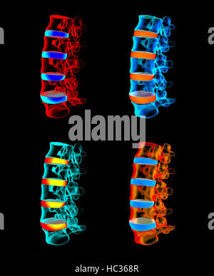 Rendu 3d - structure de la colonne vertébrale sur fond noir avec disque spinal bleu Banque D'Images