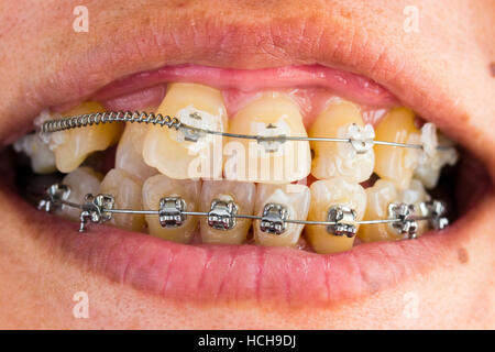 Le renfort des dents. Les deux accolades autour de la partie inférieure et supérieure dents afin de les redresser. Renfort en céramique sur le dessus des dents, metal, traditionnelle, sur la partie inférieure. Banque D'Images