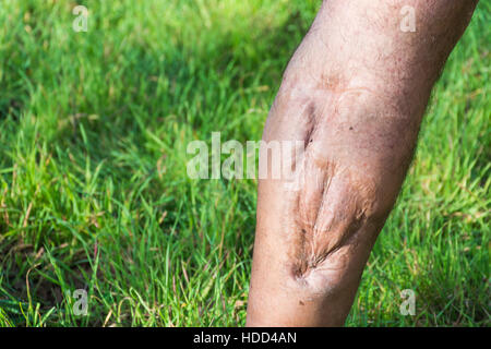 Vieille cicatrice de blessure à la jambe, de voiture ou d'accident de moto, des tissus profonds cicatrice , homme glabre de jambe, blessure à un mollet , grande cicatrice sur le mollet droit. Les cicatrices que Banque D'Images