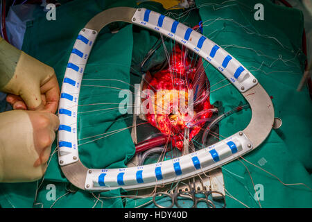 Chirurgie de remplacement de valve cardiaque, salle d'opération, Reykjavik, Islande. Banque D'Images