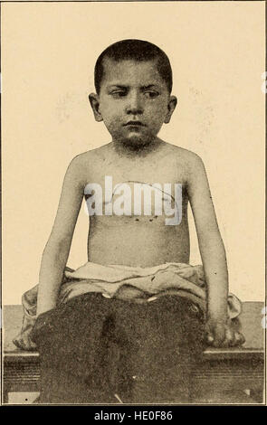 . Les maladies de la petite enfance et l'enfance Photo Stock - Alamy