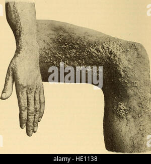 Ce traité médical de 1897 fournit des informations approfondies sur les maladies de la peau, offrant des conseils pratiques pour les étudiants et les praticiens. Il comprend des descriptions de diverses affections cutanées, des traitements et des méthodes de diagnostic, ce qui en fait une ressource essentielle pour l'étude dermatologique. Banque D'Images