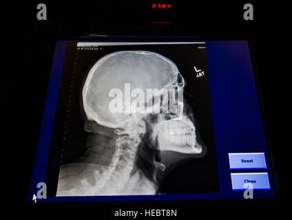 Un X-ray s'affiche sur le 376e Groupe médical expéditionnaire au centre de transit de Manas, au Kirghizistan, le 8 janvier 2014. Les rayons X sont utilisés pour détecter les fractures des os, trouver des objets étrangers dans l'organisme et de démontrer la relation entre les os et les tissus mous. (U.S. Air Force photo/Senior Airman George Goslin) Banque D'Images