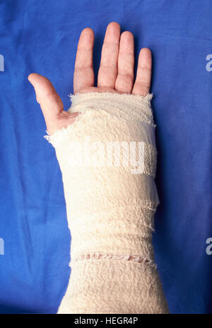 La main gauche bandée après chirurgie du canal carpien blessures Banque D'Images