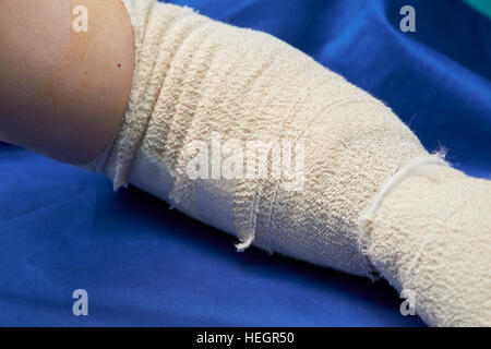 L'avant-bras gauche bandée et cubital après chirurgie du canal carpien blessures Banque D'Images