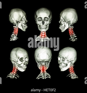 La tomodensitométrie et l'image 3D du crâne et du cou . Utilisez cette image pour la spondylose cervicale , spondylolisthésis , ankylosante traumatisme rachis , condition . Banque D'Images